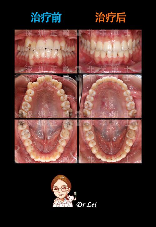 正畸导致牙弓狭窄-图2