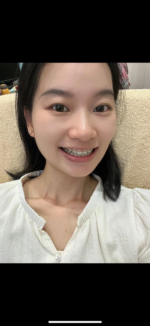 正畸 结束后照片-图1 正畸 结束后照片-图1
