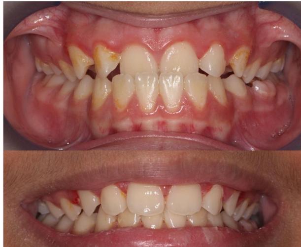 正畸 结束后照片-图3 正畸 结束后照片-图3