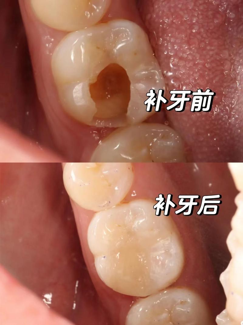 正畸科补牙？矫正期间能同时补牙吗？-图3