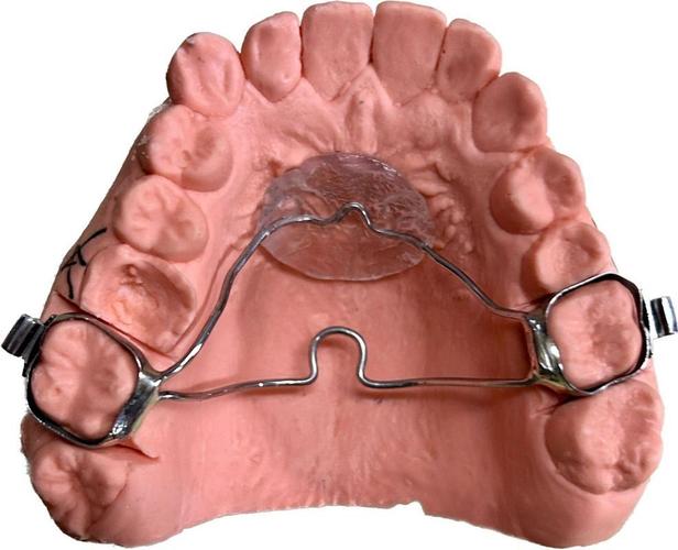 正畸腭杆制作时机-图1