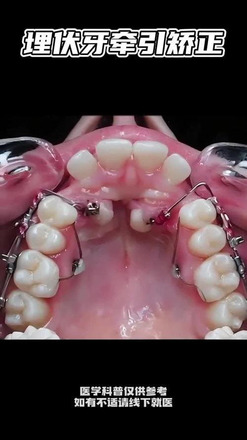 牙齿外伤正畸为何需牵出？-图1