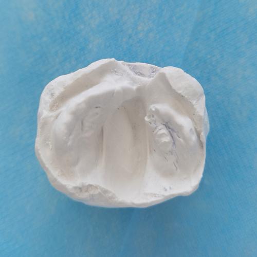 口腔正畸 唇腭裂-图3