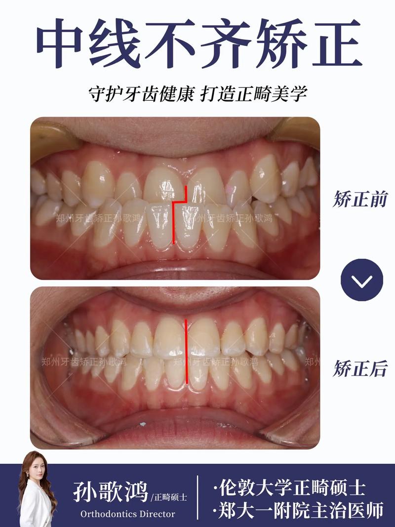 牙齿中线齐 正畸-图2