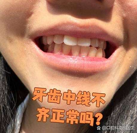 牙齿中线齐 正畸-图3
