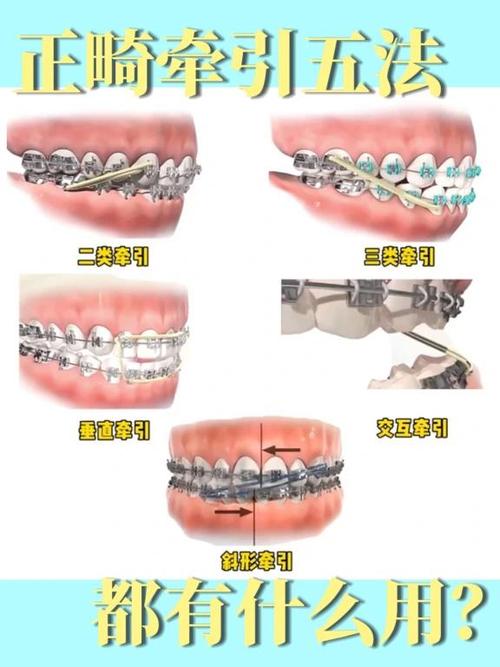 正畸牵引调整中缝-图1 正畸牵引调整中缝-图1