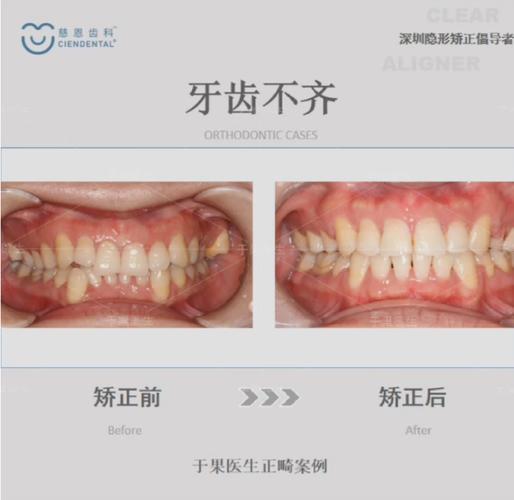 深圳口腔牙齿正畸-图2