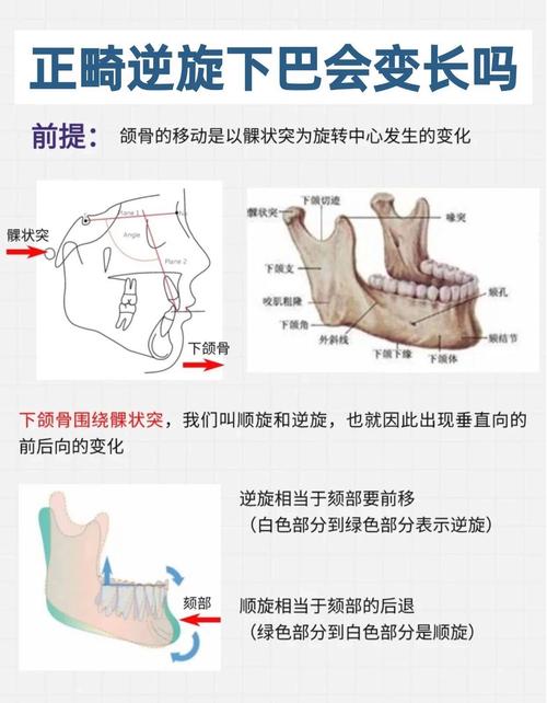 lh正畸什么原理-图3