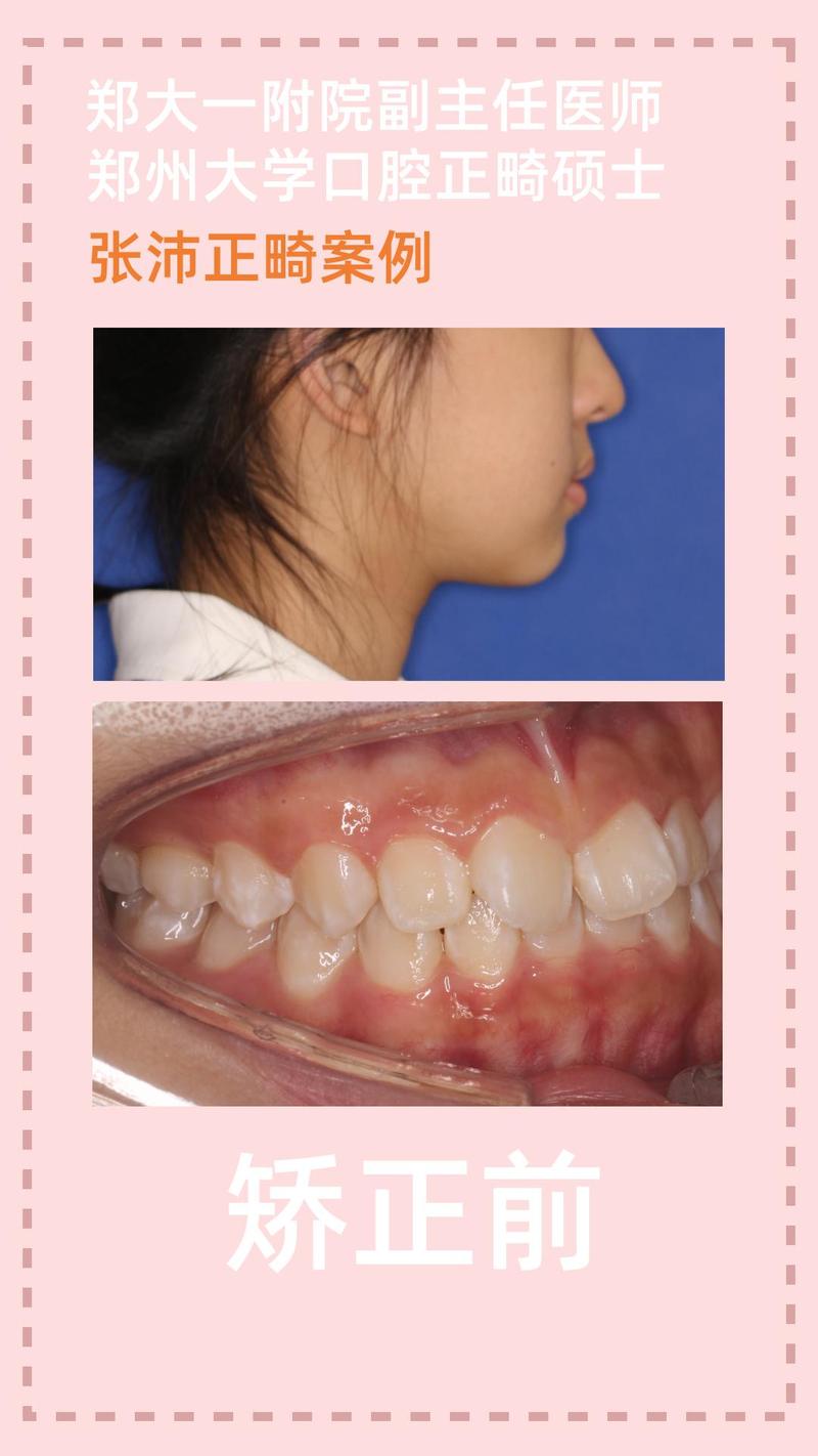 隐形正畸中线不齐是什么原因导致的?怎么解决比较好?-图2 隐形正畸中线不齐是什么原因导致的?怎么解决比较好?-图2