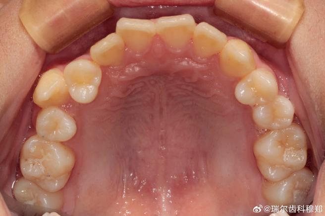 隐形正畸中线不齐是什么原因导致的?怎么解决比较好?-图3 隐形正畸中线不齐是什么原因导致的?怎么解决比较好?-图3