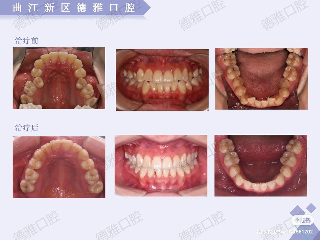 口腔正畸病例视频效果如何？看完能改善牙齿吗？-图3