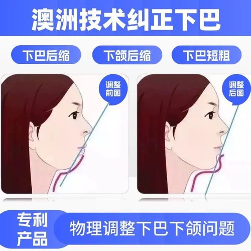 正畸治疗会影响颞下颌关节健康吗？-图3