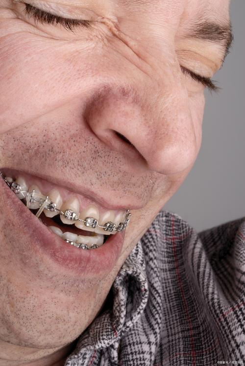 美国牙齿成人正畸-图2 美国牙齿成人正畸-图2