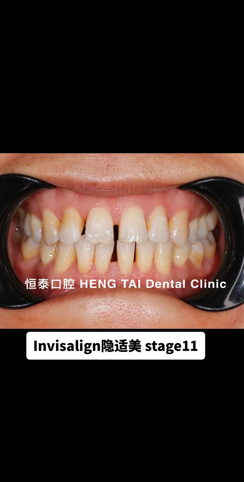 美国牙齿成人正畸-图3 美国牙齿成人正畸-图3