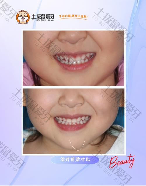 正畸时有乳牙，会影响牙齿矫正效果吗？-图1