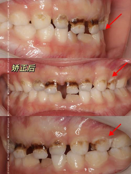 正畸时有乳牙，会影响牙齿矫正效果吗？-图2