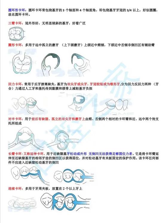 口腔正畸卡环分类有哪些常见类型及分类依据？-图2