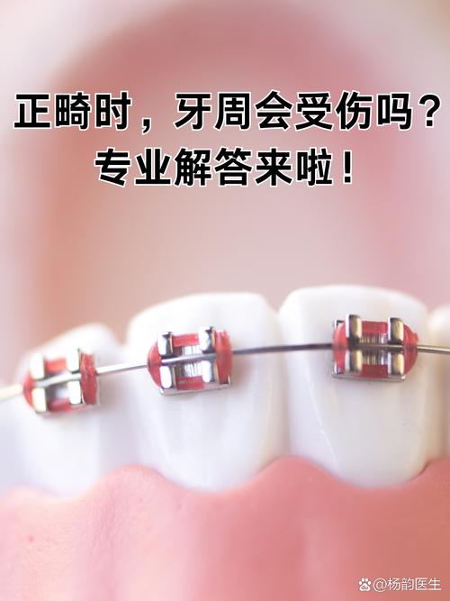 牙周健康与正畸矫正，如何相互影响与协同？-图2