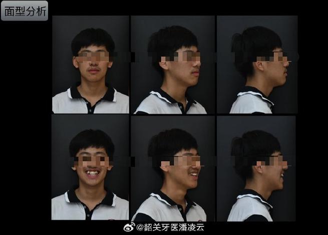 光华为何不做术前正畸？背后有何考量？-图1