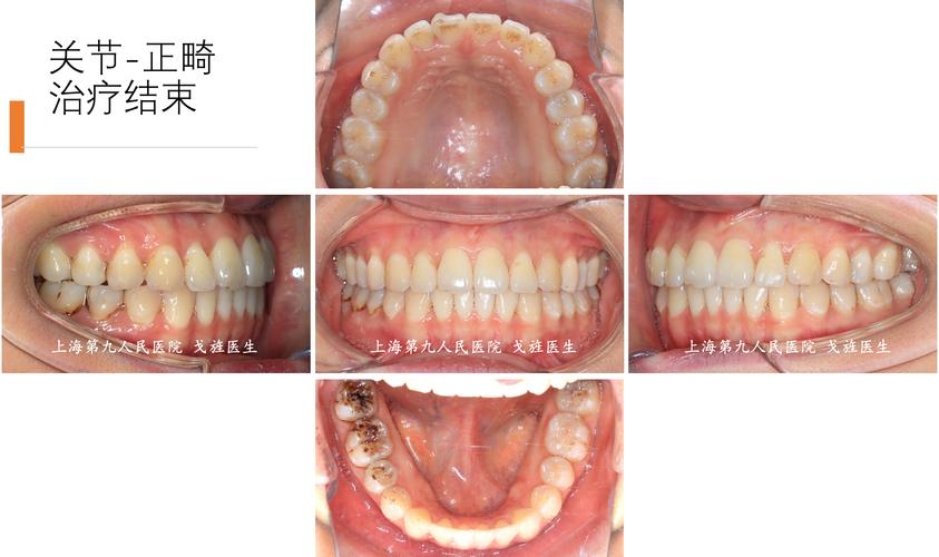 光华为何不做术前正畸？背后有何考量？-图3