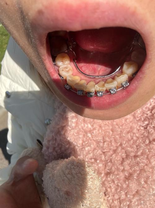 正畸内侧颚骨吸收，原因是什么？如何应对？-图1