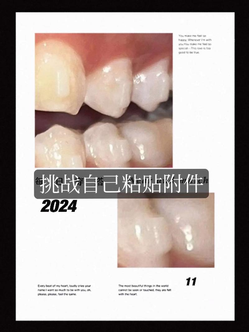 牙齿正畸牙齿附件-图2