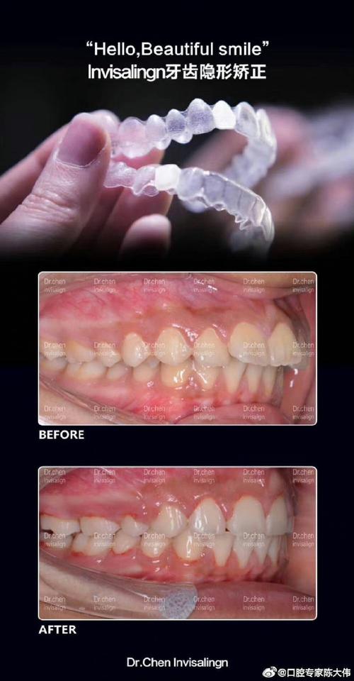 牙齿隐形正畸手术-图3