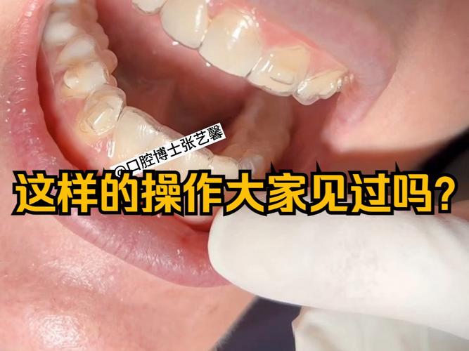 正畸隐形矫治附件对矫治效果有何关键影响？-图3