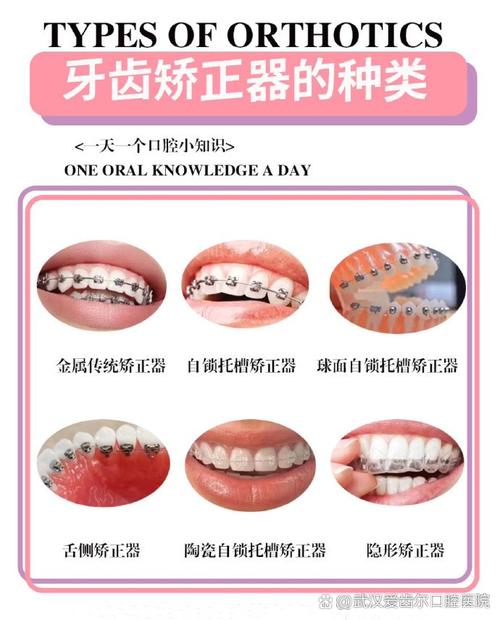 牙科正畸钢丝种类有哪些？如何挑选适合自己的？-图2
