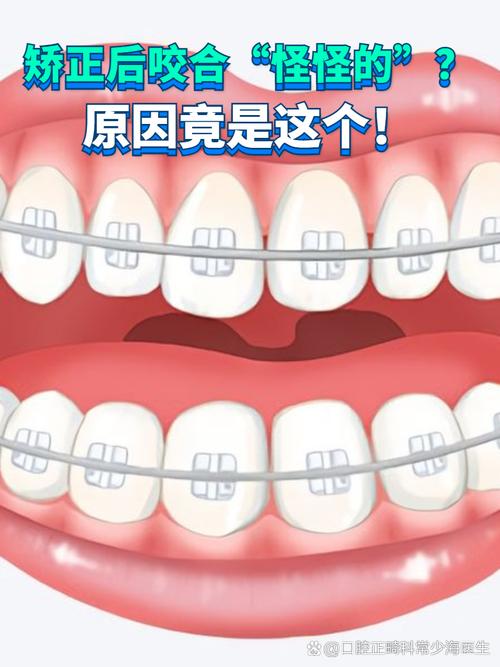 正畸调整咬合失败-图1 正畸调整咬合失败-图1