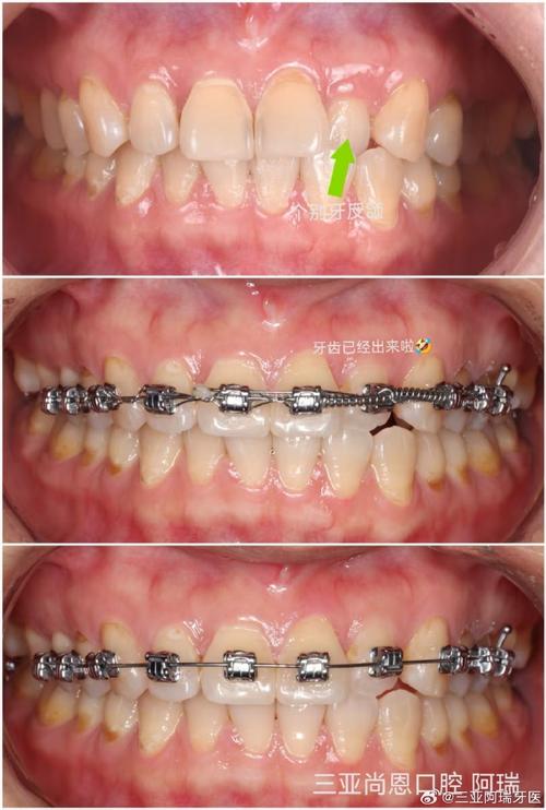 正畸拍摄图片方法-图2