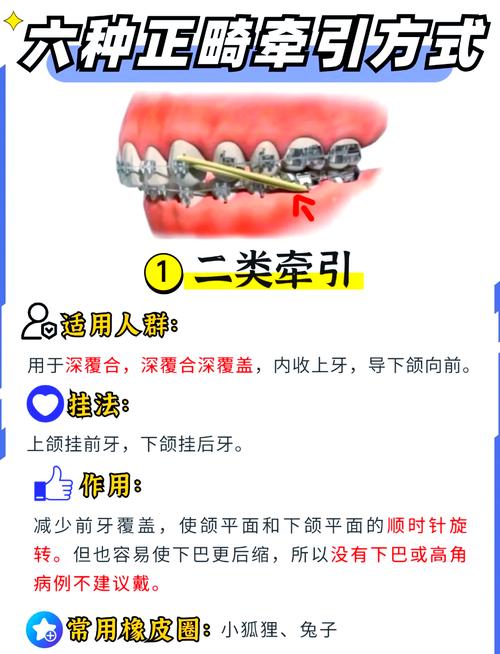 正畸牙齿左右牵引-图1
