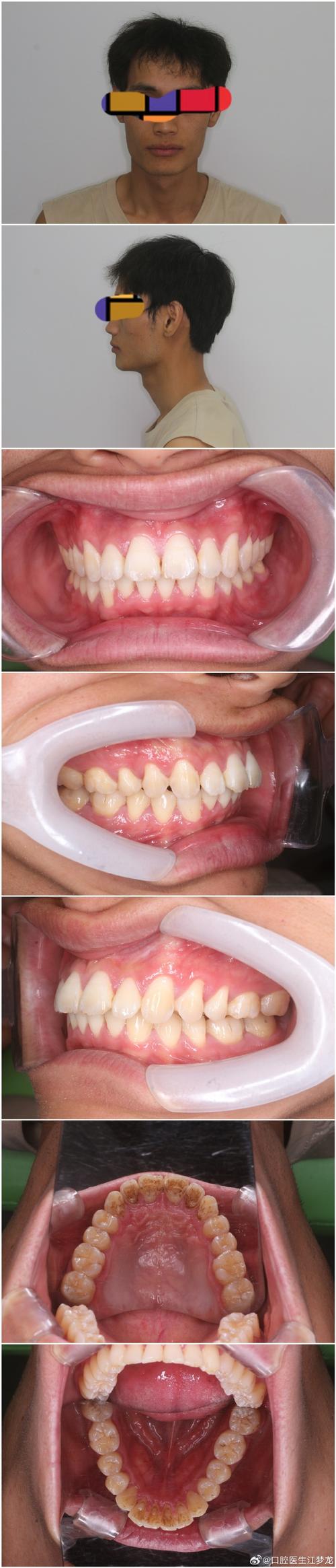 倾斜后牙正畸直立-图1
