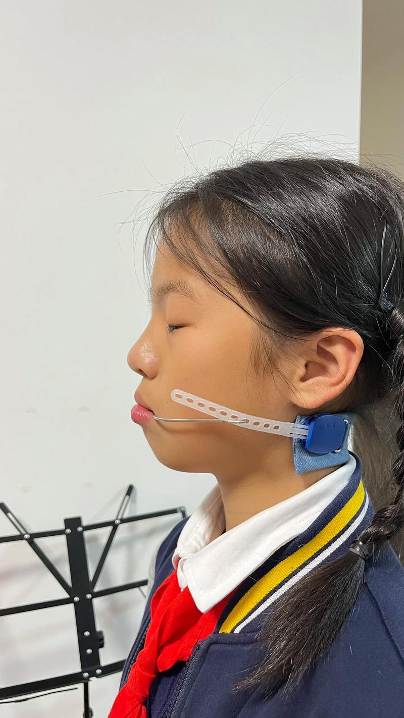 倾斜后牙正畸直立-图2