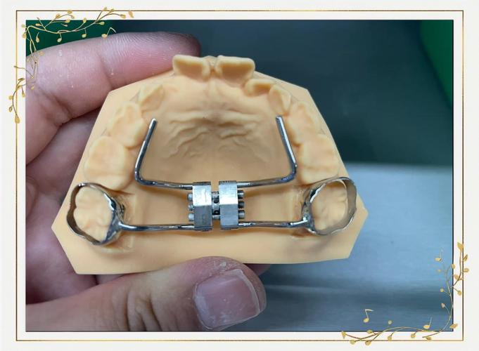 正畸片段弓是什么？矫正效果如何？适合哪些情况？-图2