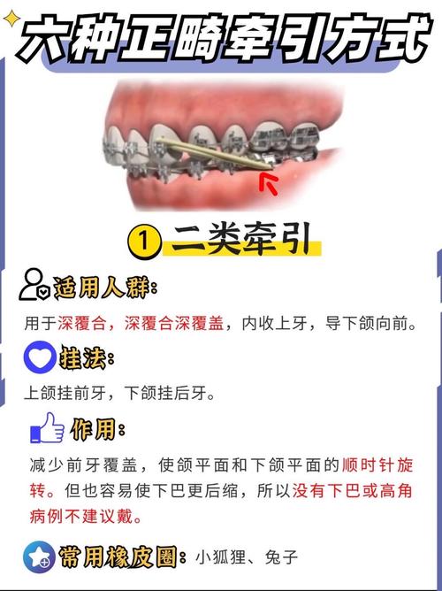 正畸下颌牵引装置矫正下颌畸形效果如何？-图2