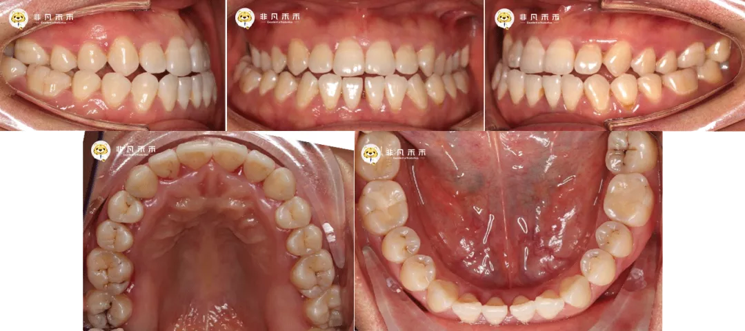 北医正畸病例采集-图3