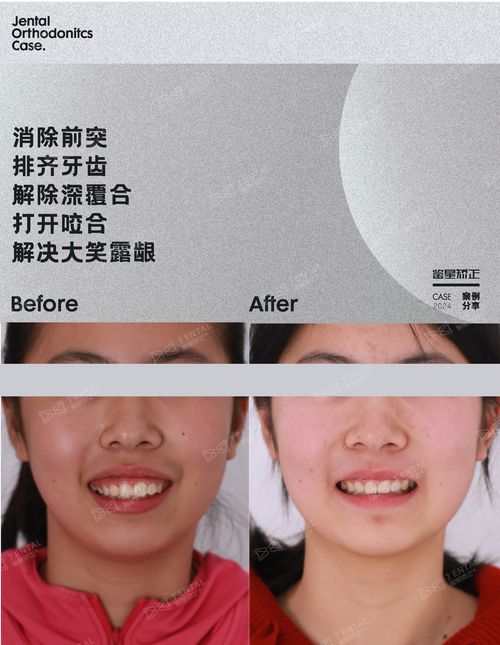 正畸牙齿后移牙床-图2