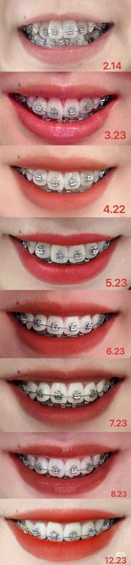 口腔正畸拍照视频-图2