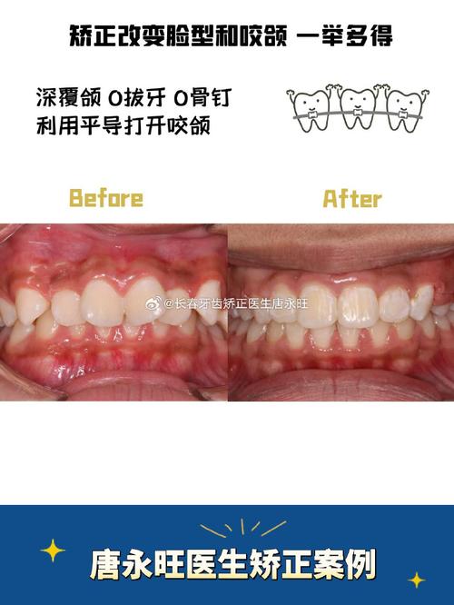 青年正畸案例，矫正周期长，效果与疼痛如何平衡？-图3