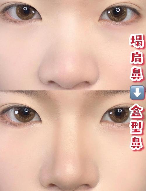 掩饰性正畸能改善鼻子外观吗？-图1