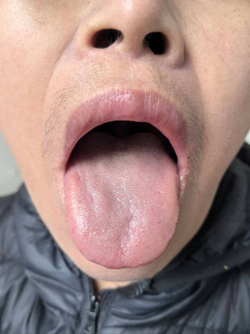 正畸带环牙痛流血是什么原因？-图1