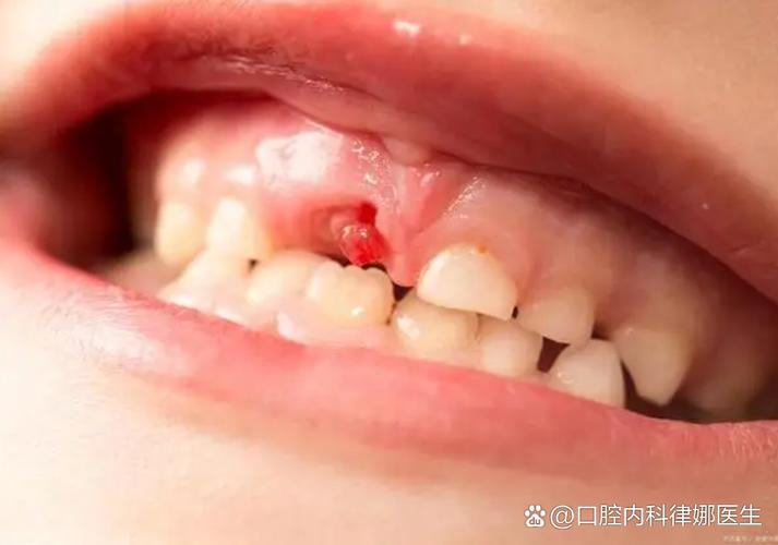 正畸带环牙痛流血是什么原因？-图2