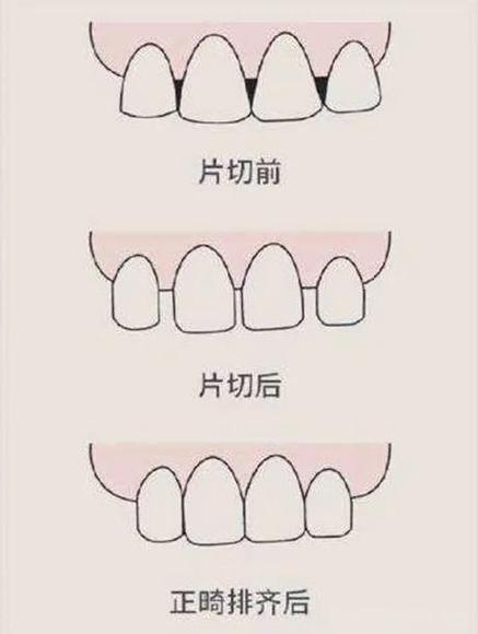 正畸邻面接触关系-图1