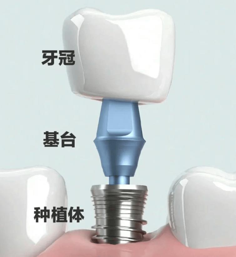 牙周正畸种植,治疗顺序如何定?-图2 牙周正畸种植,治疗顺序如何定?-图2