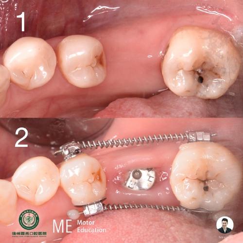 牙周正畸种植,治疗顺序如何定?-图3 牙周正畸种植,治疗顺序如何定?-图3