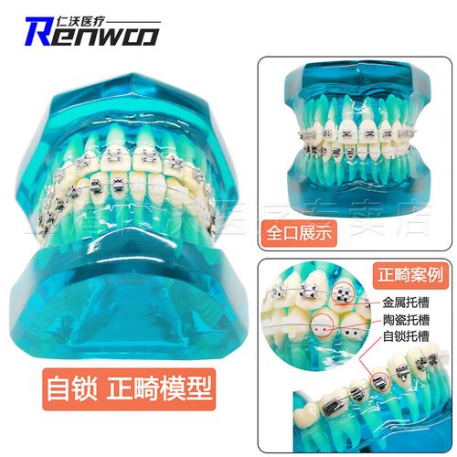 正畸陶瓷托槽优点何在？美观与舒适度如何兼顾？-图3