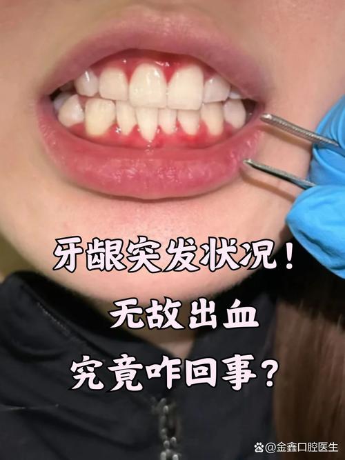 正畸牙龈出血严重-图1