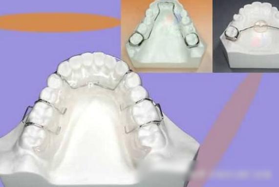 正畸关闭间隙材料-图3