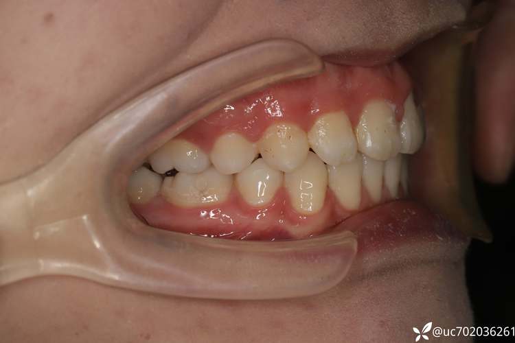 正畸咬合平面倾斜-图2